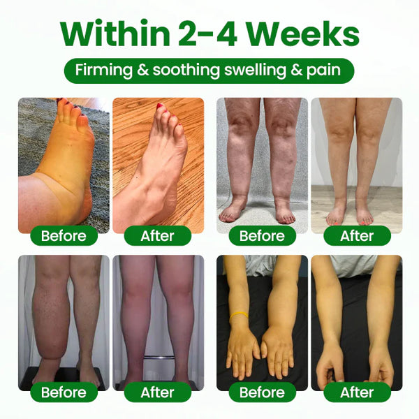 VeinFlex Magnesium Spray for Vein Relief 🔥 FDA Certified (Clinically proven relief for swollen legs, poor circulation, and varicose veins 🩺)