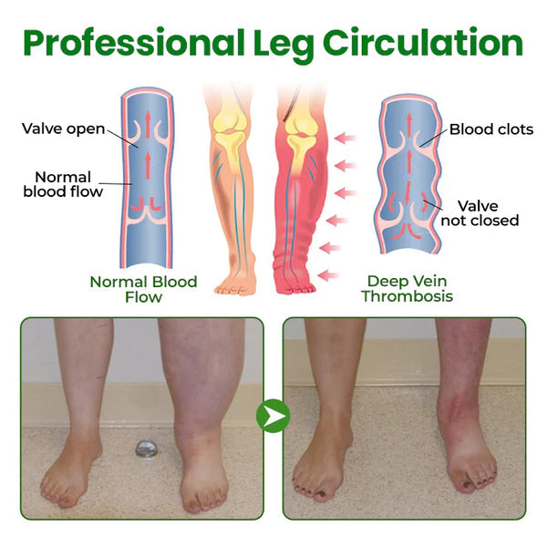 VeinFlex Magnesium Spray for Vein Relief 🔥 FDA Certified (Clinically proven relief for swollen legs, poor circulation, and varicose veins 🩺)