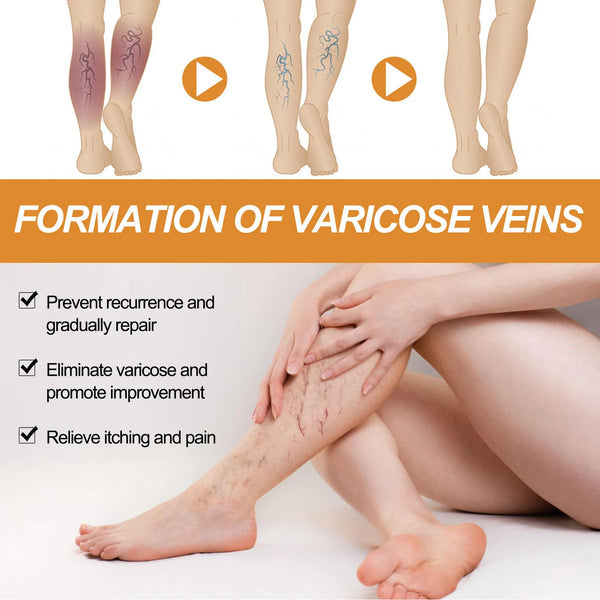 🌿 Varicose Vein Relief Spray – Soothing Comfort in Every Spray! 💧@549