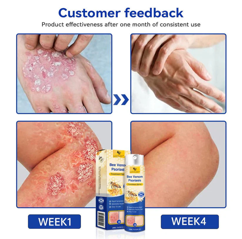🐝Bee Venom Fungal Eczema Spray Pro++