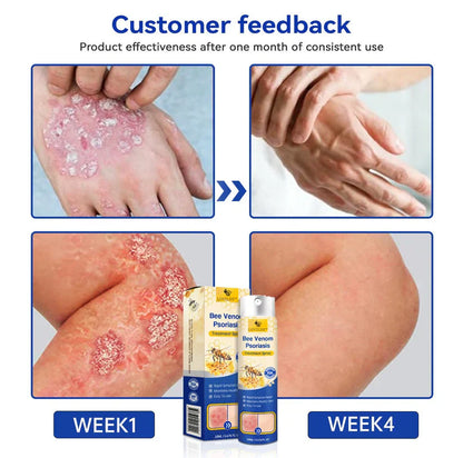 🐝Bee Venom Fungal Eczema Spray Pro++
