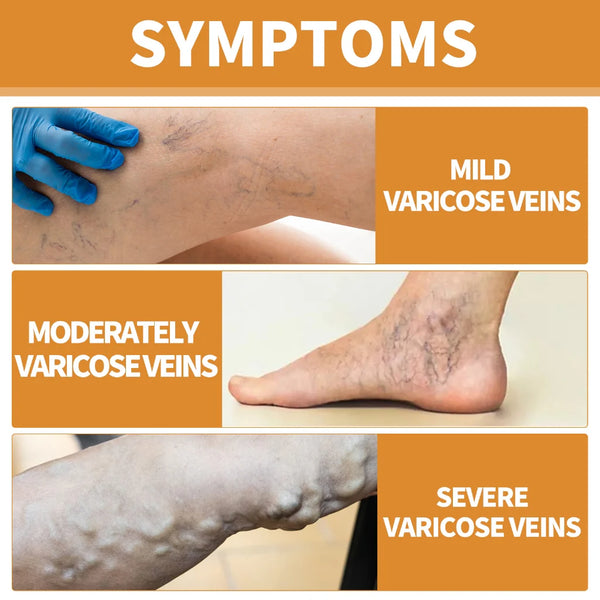 🌿 Varicose Vein Relief Spray – Soothing Comfort in Every Spray! 💧@549