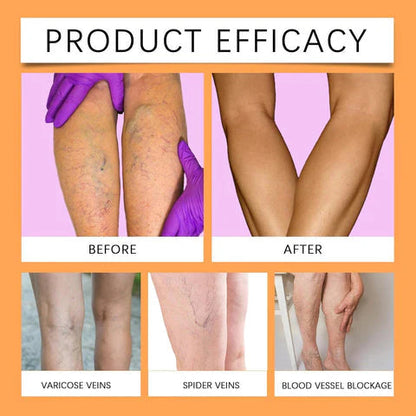 🌿 Varicose Vein Relief Spray – Soothing Comfort in Every Spray! 💧@549