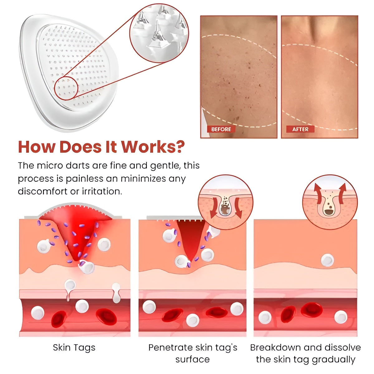 DermaSmooth - Skin Tags & Pimple Removal PATCH (Buy 36 Get 36 Free)