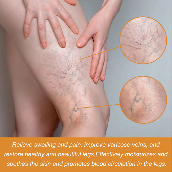 🌿 Varicose Vein Relief Spray – Soothing Comfort in Every Spray! 💧@549