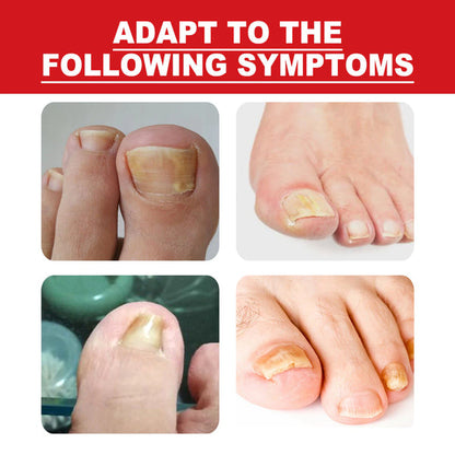 SouthMoon Ingrown Toenail Drops Nail Fungal Repair( BUY 1 GET 1 FREE)